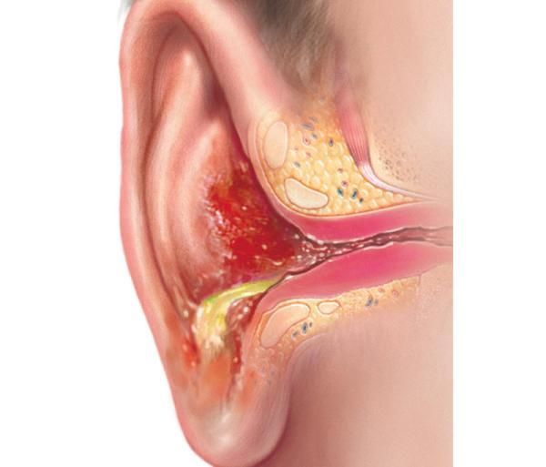 عفونت گوش خارجی یا گوش شناگران یا اوتیت خارجی چیست و چطور درمان می گردد؟