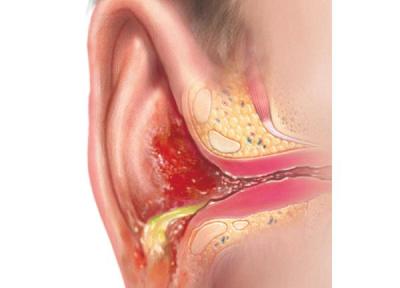 عفونت گوش خارجی یا گوش شناگران یا اوتیت خارجی چیست و چطور درمان می گردد؟